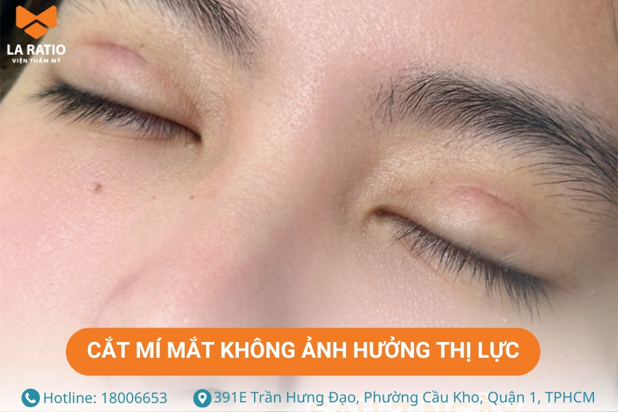 Cắt mí mắt không ảnh hưởng đến thị lực nếu được thực hiện tại cơ sở thẩm mỹ uy tín Cắt mí mắt không ảnh hưởng đến thị lực nếu được thực hiện tại cơ sở thẩm mỹ uy tín