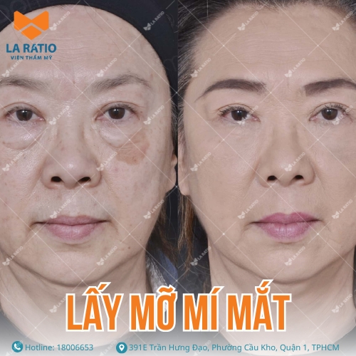 hình ảnh khách hàng trước và sau khi lấy mỡ mí mắt tại la ratio