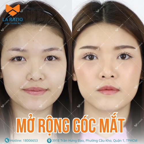 hình ảnh khách hàng trước và sau khi mở rộng góc mắt tại la ratio