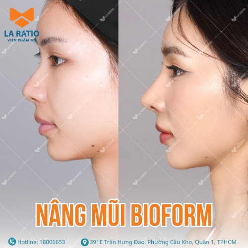 hình ảnh khách hàng trước và sau khi nâng mũi bioform tại la ratio