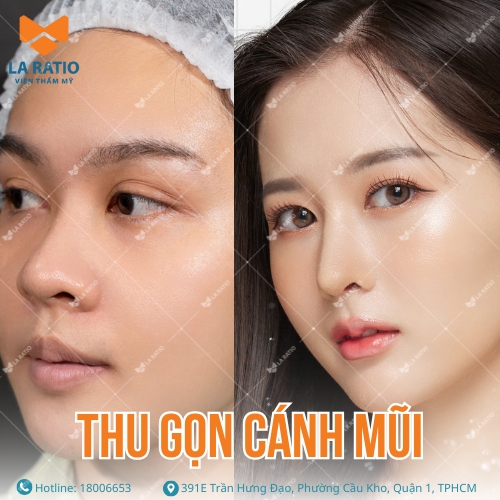 hình ảnh khách hàng trước và sau khi thu gọn cánh mũi tại la ratio