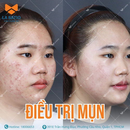 hình ảnh khách hàng trước và sau khi trị mụn tại la ratio
