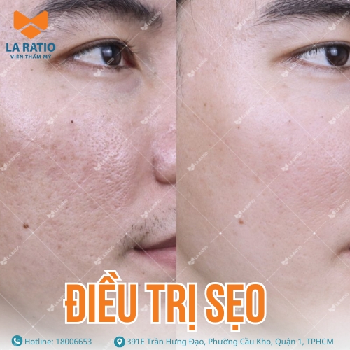 hình ảnh khách hàng trước và sau khi trị sẹo tại la ratio
