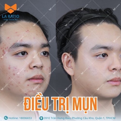 hình ảnh trước sau trị mụn chuẩn y khoa tại la ratio