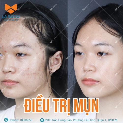 hình trước và sau khi trị mụn tại viện thẩm mỹ la ratio