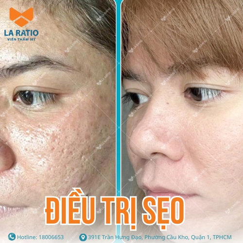 hình ảnh trước và sau khi điều trị sẹo tại la ratio