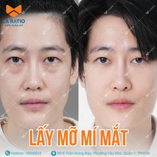 hình ảnh trước và sau khi lấy mỡ mí mắt tại la ratio