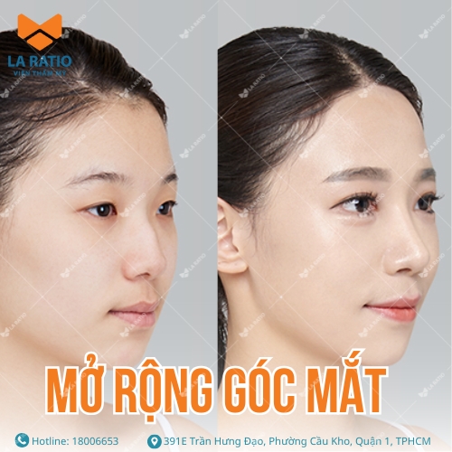 hình ảnh trước và sau khi mở rộng góc mắt tại la ratio