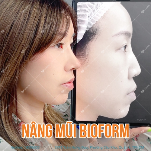 hình ảnh trước và sau khi nâng mũi bioform tại la ratio