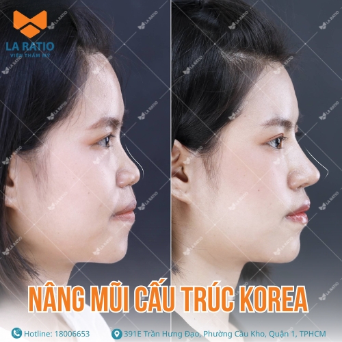 hình ảnh trước và sau khi nâng mũi cấu trúc korea tại la ratio
