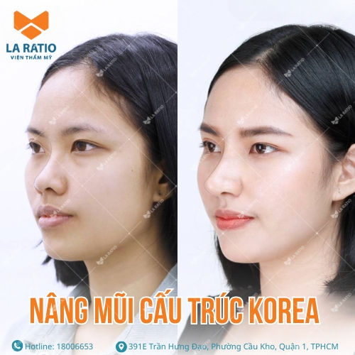 hình ảnh trước và sau khi nâng mũi hàn quốc tại la ratio