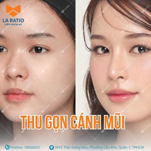 hình ảnh trước và sau khi thu gọn cánh mũi tại la ratio
