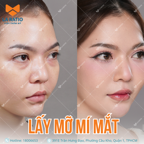 hình trước và sau khi lấy mỡ mí mắt tại viện thẩm mỹ la ratio