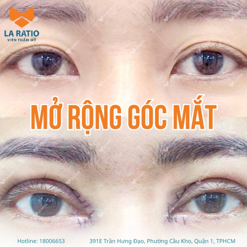 hình trước và sau khi mở rộng góc mắt tại viện thẩm mỹ la ratio