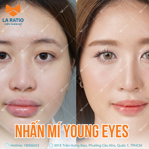 hình trước và sau khi nhấn mí young eyes tại viện thẩm mỹ la ratio