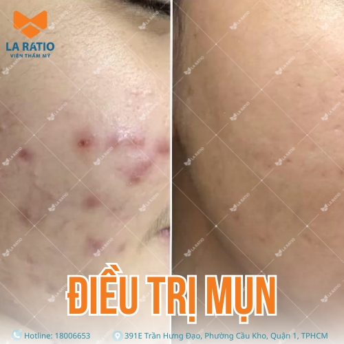 hình trước và sau khi trị mụn tại viện thẩm mỹ la ratio