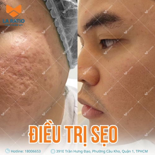 hình trước và sau khi trị sẹo tại viện thẩm mỹ la ratio