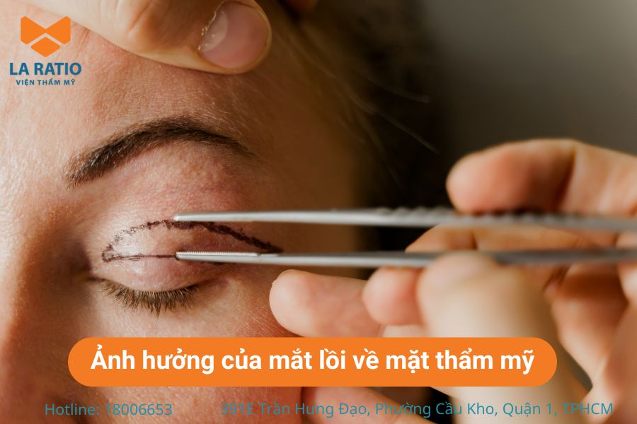 Mắt lồi gây ảnh hưởng nghiêm trọng đến tính thẩm mỹ Mắt lồi gây ảnh hưởng nghiêm trọng đến tính thẩm mỹ