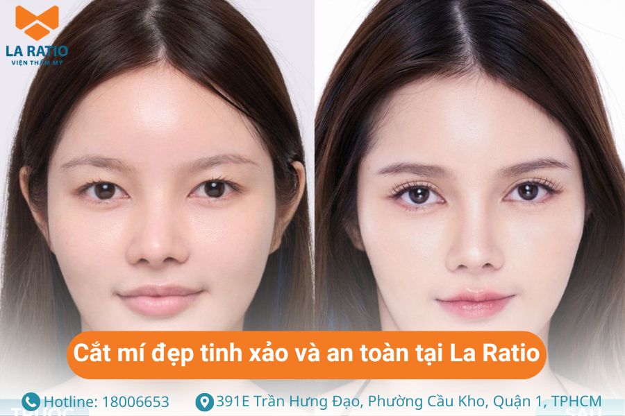 Khách hàng trước và sau khi cắt mí mắt tại La Ratio Khách hàng trước và sau khi cắt mí mắt tại La Ratio