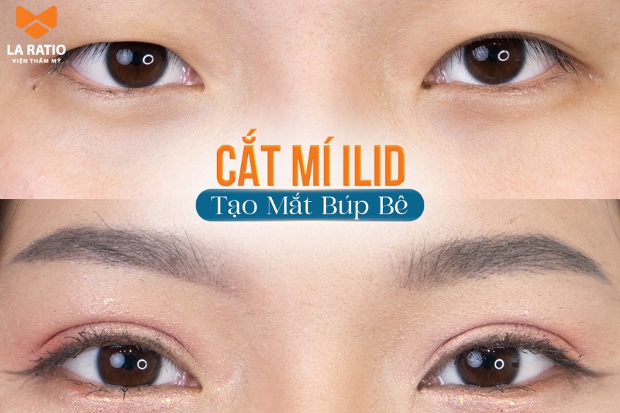 Cắt mí tạo hình đôi mắt hai mí rõ nét Cắt mí tạo hình đôi mắt hai mí rõ nét