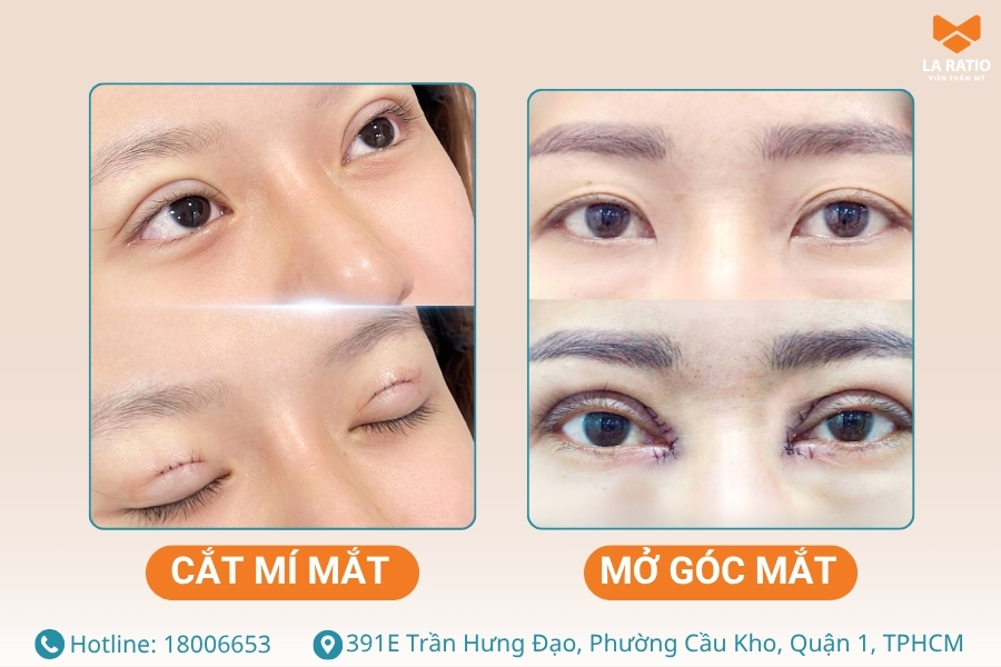 Cắt mí mắt và mở góc mắt là 2 kỹ thuật tạo hình thẩm mỹ mắt khác nhau Cắt mí mắt và mở góc mắt là 2 kỹ thuật tạo hình thẩm mỹ mắt khác nhau