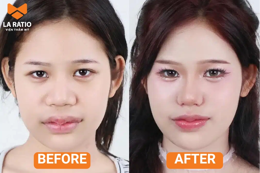 Nên chỉnh sửa mũi cà chua khi dáng mũi này ảnh hưởng đến thẩm mỹ và sự tự tin của bạn Nên chỉnh sửa mũi cà chua khi dáng mũi này ảnh hưởng đến thẩm mỹ và sự tự tin của bạn