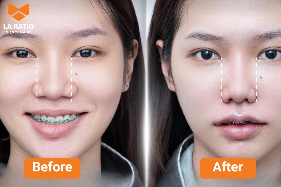 Có nên chỉnh sửa mũi trâu hay không tùy thuộc vào mong muốn của mỗi người Có nên chỉnh sửa mũi trâu hay không tùy thuộc vào mong muốn của mỗi người