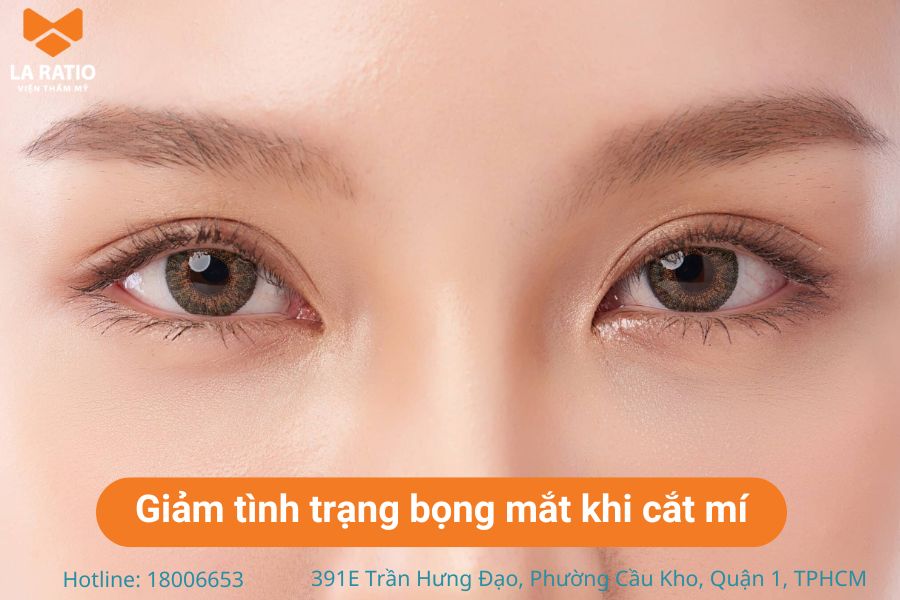 Cắt mí mắt có thể giúp làm giảm tình trạng xuất hiện bọng mắt Cắt mí mắt có thể giúp làm giảm tình trạng xuất hiện bọng mắt