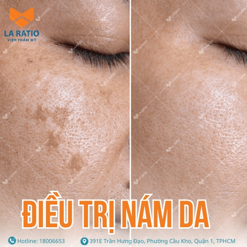 hình ảnh khách hàng trước và sau khi trị nám tại la ratio