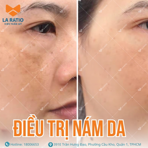 hình ảnh trước và sau khi điều trị nám da tại la ratio