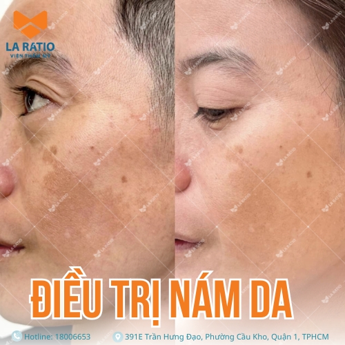 hình trước và sau khi trị nám da tại viện thẩm mỹ la ratio