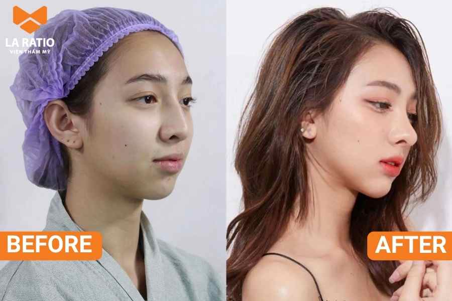 Nâng mũi cấu trúc can thiệp vào cấu trúc bên trong mũi, giúp loại bỏ sống mũi gồ và các khuyết điểm mũi Nâng mũi cấu trúc can thiệp vào cấu trúc bên trong mũi, giúp loại bỏ sống mũi gồ và các khuyết điểm mũi