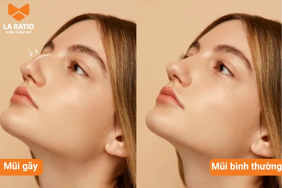 So với dáng mũi thông thường, mũi gãy sẽ có điểm bị gãy khúc, đứt đoạn hoặc gồ cao So với dáng mũi thông thường, mũi gãy sẽ có điểm bị gãy khúc, đứt đoạn hoặc gồ cao