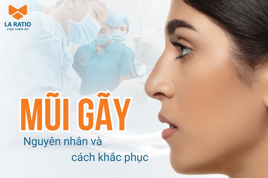 Mũi gãy là thế nào? Nguyên nhân và cách khắc phục sống mũi bị gãy Mũi gãy là thế nào? Nguyên nhân và cách khắc phục sống mũi bị gãy