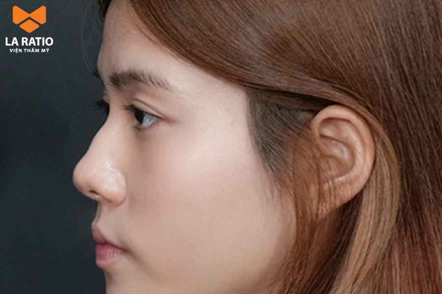 Mũi gồ không được đánh giá là dáng mũi đẹp Mũi gồ không được đánh giá là dáng mũi đẹp