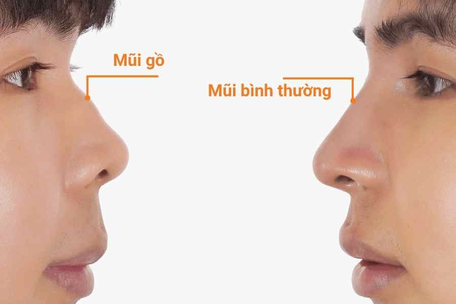 Mũi gồ có phần sống mũi bị nhô lên bất thường Mũi gồ có phần sống mũi bị nhô lên bất thường