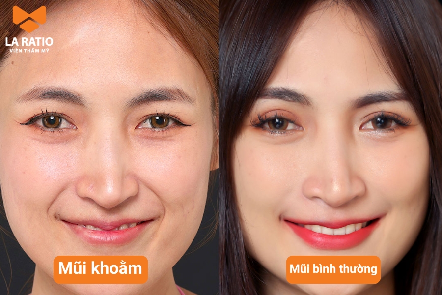 Mũi khoằm có hình dáng tựa như mũi của con chim ưng với phần đầu mũi chúc xuống và quặp vào miệng Mũi khoằm có hình dáng tựa như mũi của con chim ưng với phần đầu mũi chúc xuống và quặp vào miệng