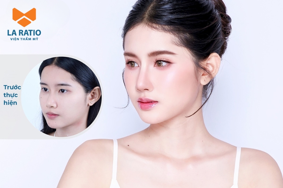  Nâng mũi cao tây tạo sống mũi cao, thẳng và sắc nét