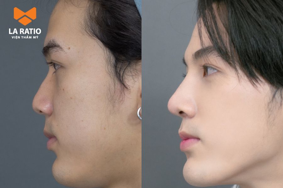 Dáng mũi L Line phù hợp với khuôn mặt có phần góc cạnh