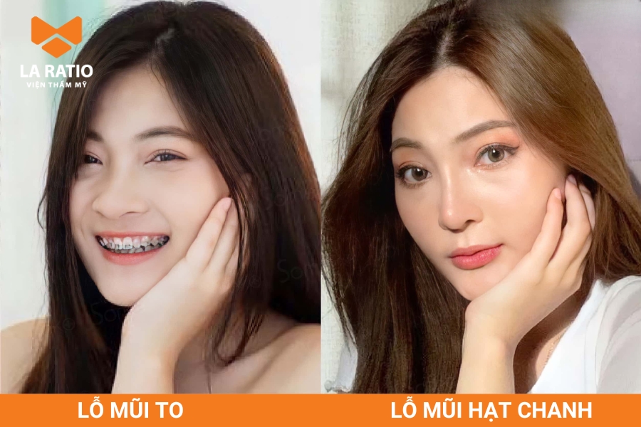 Mũi hạt chanh dù nhìn nghiêng hay thẳng đều không lộ rõ lỗ mũi Mũi hạt chanh dù nhìn nghiêng hay thẳng đều không lộ rõ lỗ mũi