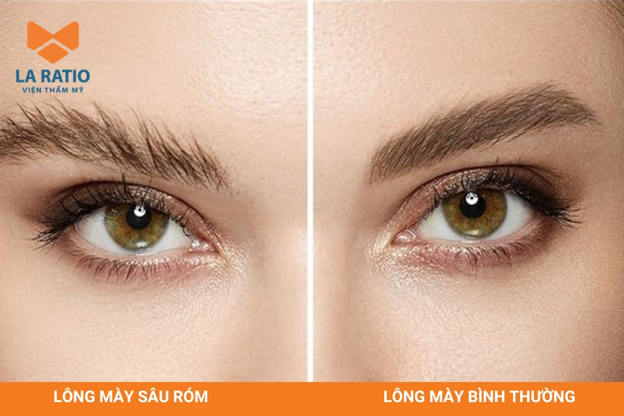 Chân mày sâu róm mọc lởm chởm, các sợi lông mày xoắn vào nhau Chân mày sâu róm mọc lởm chởm, các sợi lông mày xoắn vào nhau