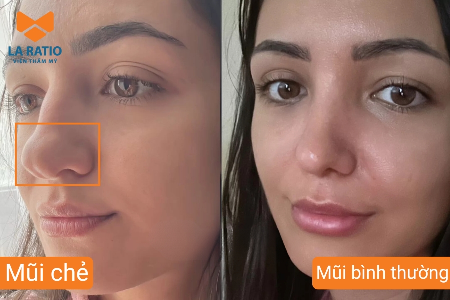 Mũi chẻ là dáng mũi bị chẻ đôi ở đầu mũi Mũi chẻ là dáng mũi bị chẻ đôi ở đầu mũi