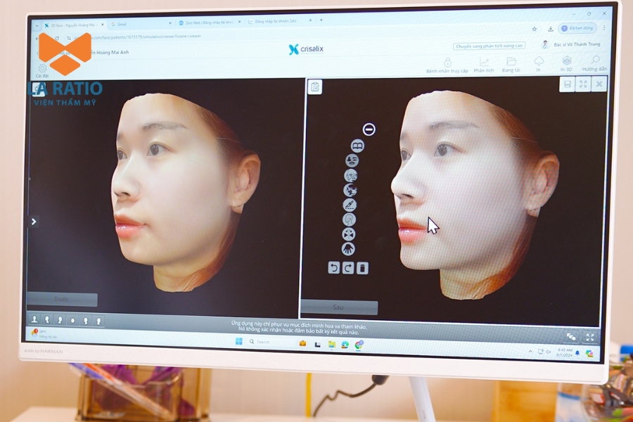 Công nghệ mô phỏng 3D giúp phân tích dáng mũi trước và sau khi nâng Công nghệ mô phỏng 3D giúp phân tích dáng mũi trước và sau khi nâng