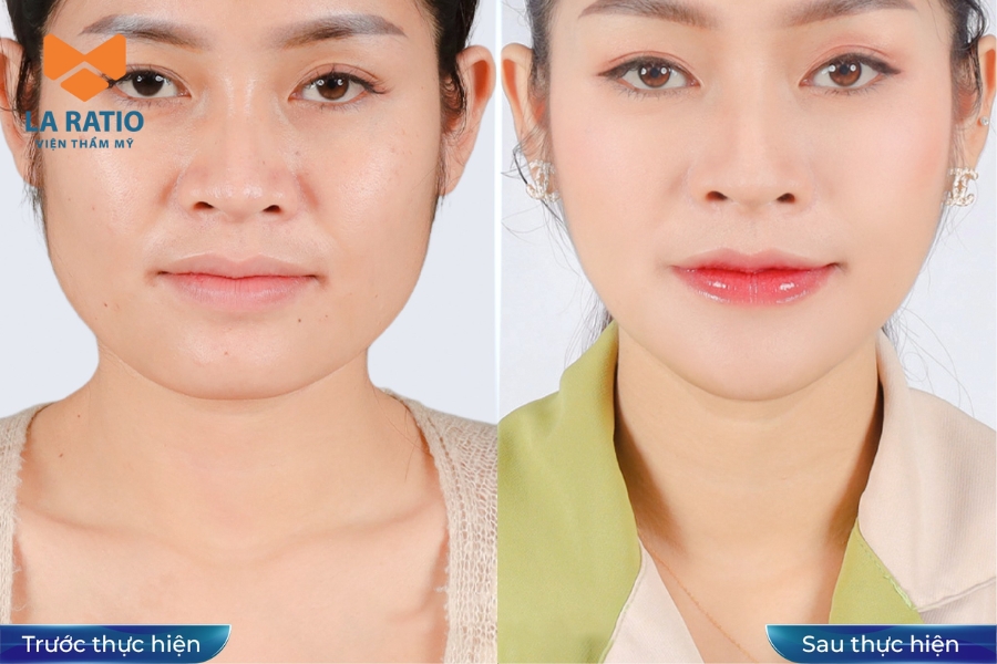 Nâng mũi cấu trúc giúp định hình lại dáng mũi từ sống mũi đến đầu mũi và cánh mũi Nâng mũi cấu trúc giúp định hình lại dáng mũi từ sống mũi đến đầu mũi và cánh mũi