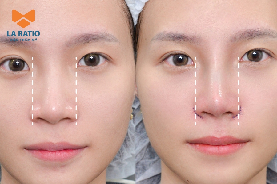 Có thể cân nhắc chỉnh sửa nếu dáng mũi hiện tại chưa hài hòa Có thể cân nhắc chỉnh sửa nếu dáng mũi hiện tại chưa hài hòa