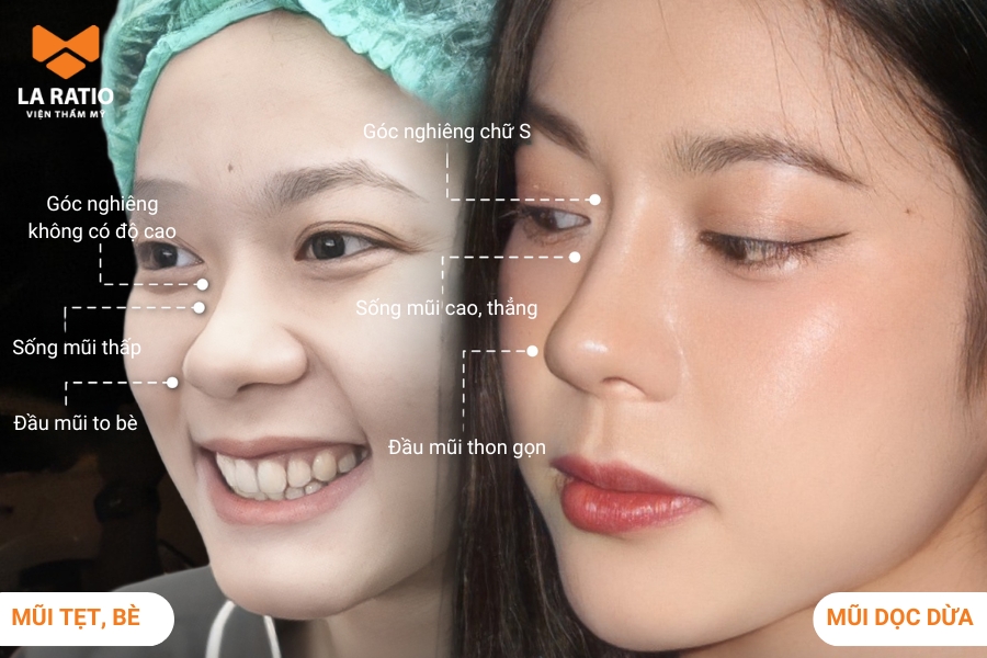 Hình ảnh mũi dọc dừa Hình ảnh mũi dọc dừa