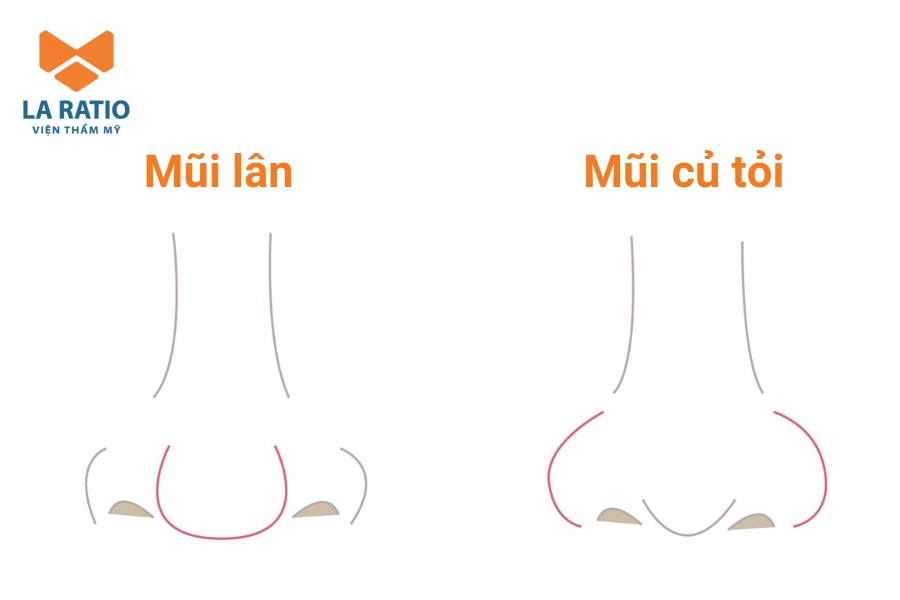 Mũi lân tạo cảm giác khuôn mặt nặng nề hơn so với dáng mũi củ tỏi Mũi lân tạo cảm giác khuôn mặt nặng nề hơn so với dáng mũi củ tỏi