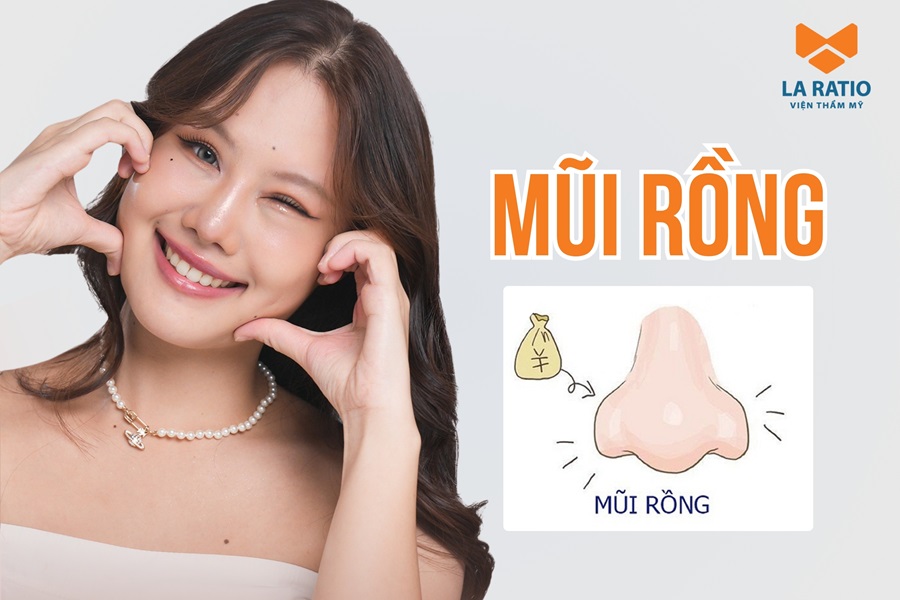 Mũi rồng là gì? Người có mũi rồng có nên sửa mũi không? Mũi rồng là gì? Người có mũi rồng có nên sửa mũi không?