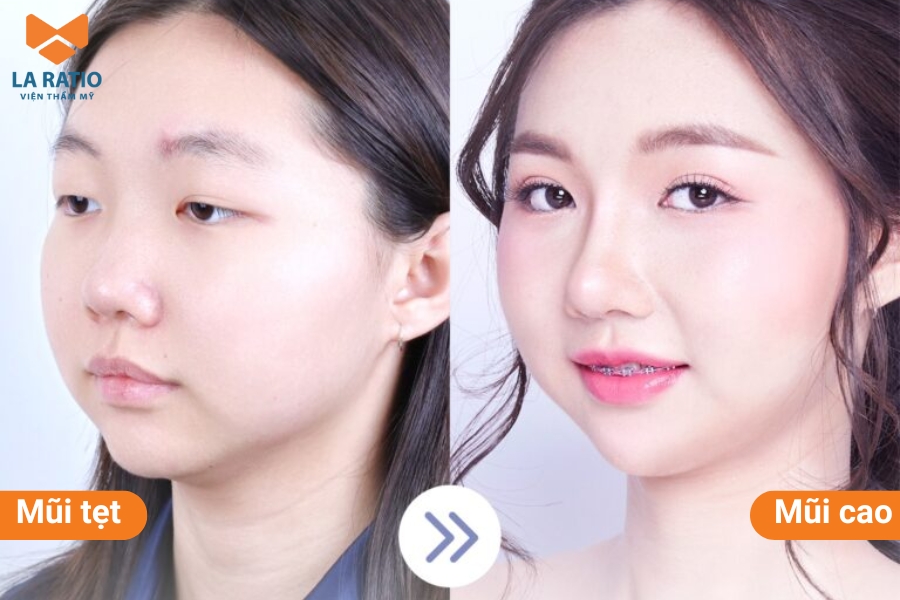 Mũi tẹt không phải là dáng mũi đẹp Mũi tẹt không phải là dáng mũi đẹp