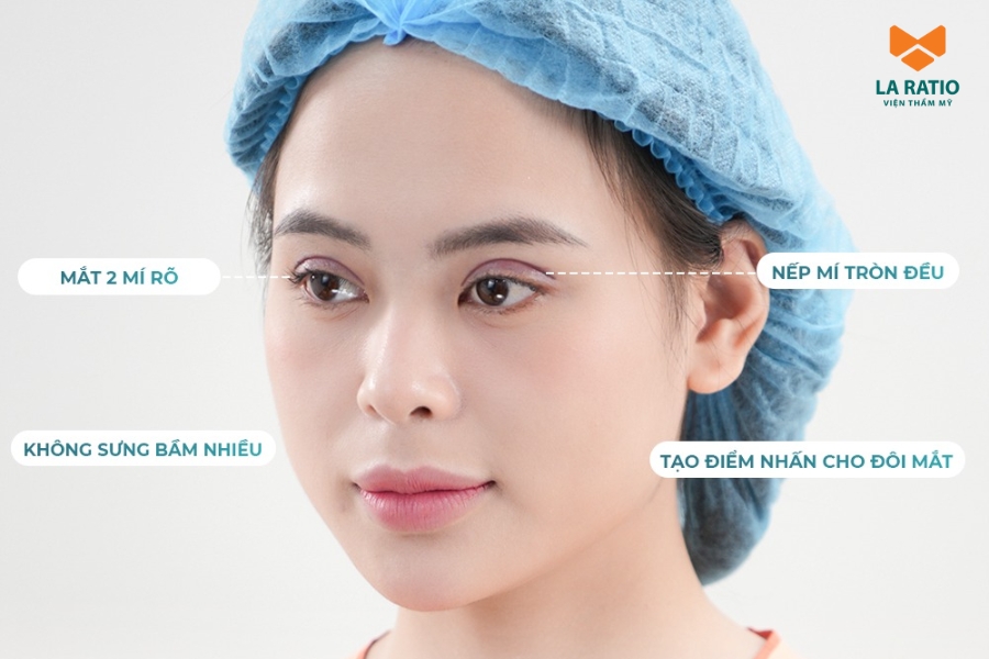 Công nghệ cắt mí ILID giúp mí mắt nhanh hồi phục - hạn chế sưng bầm